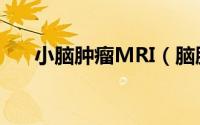 小脑肿瘤MRI（脑肿瘤MRI诊断进阶）